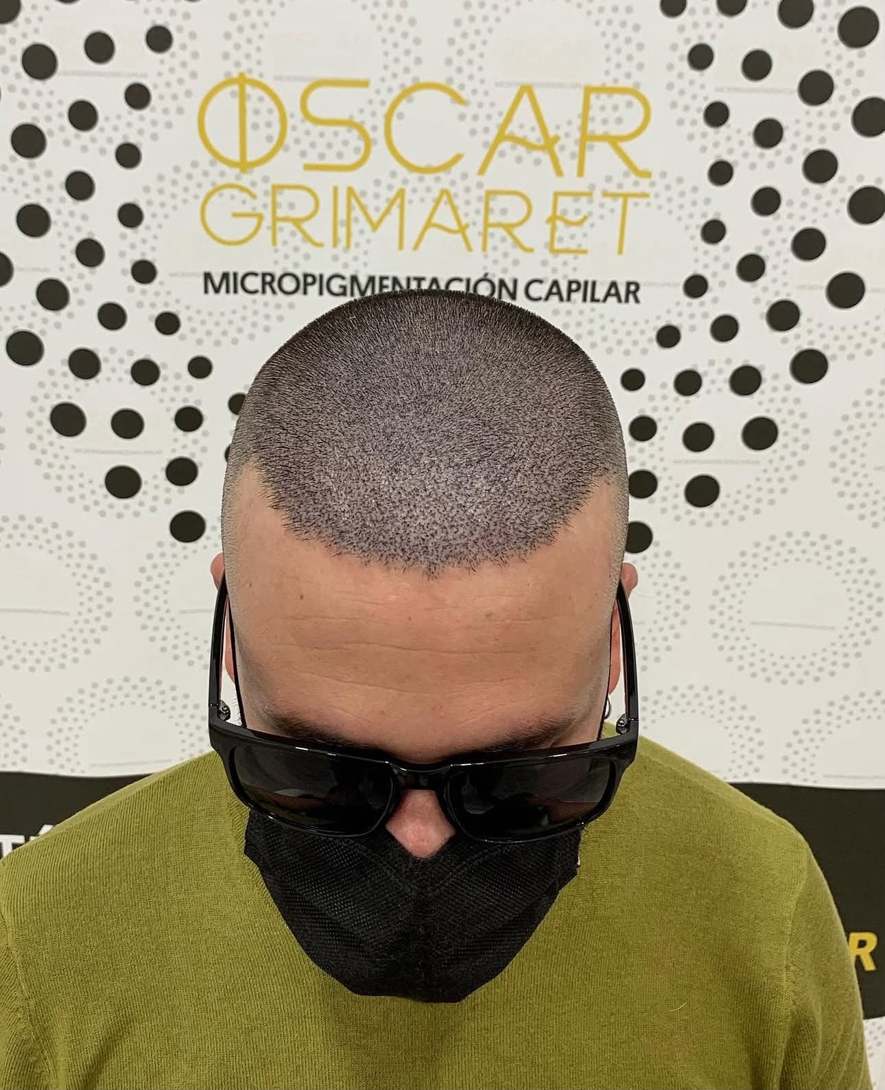 Diseño frontal personalizado de micropigmentación capilar