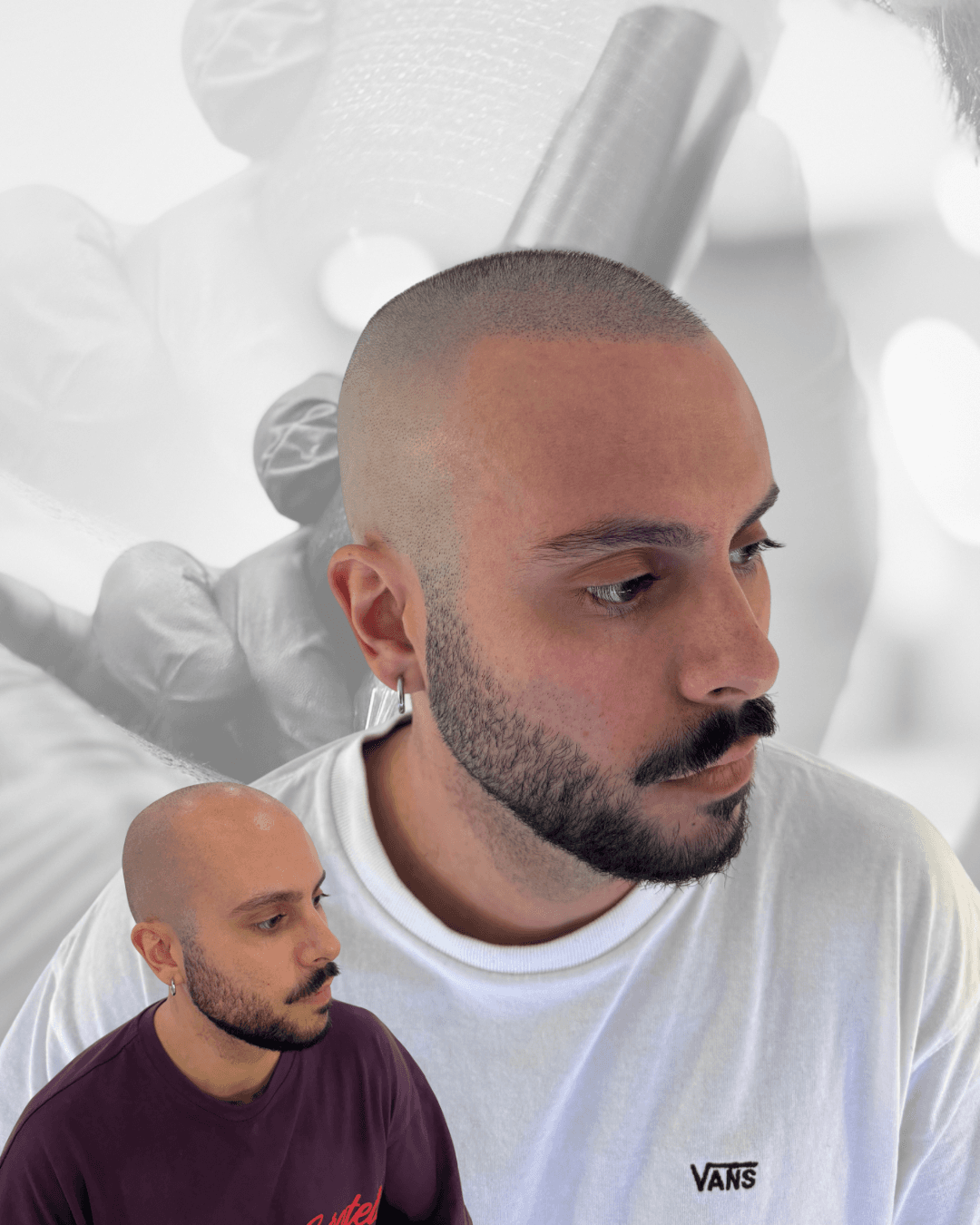 Comparativa de un resultado de micropigmentación capilar con efecto rapado