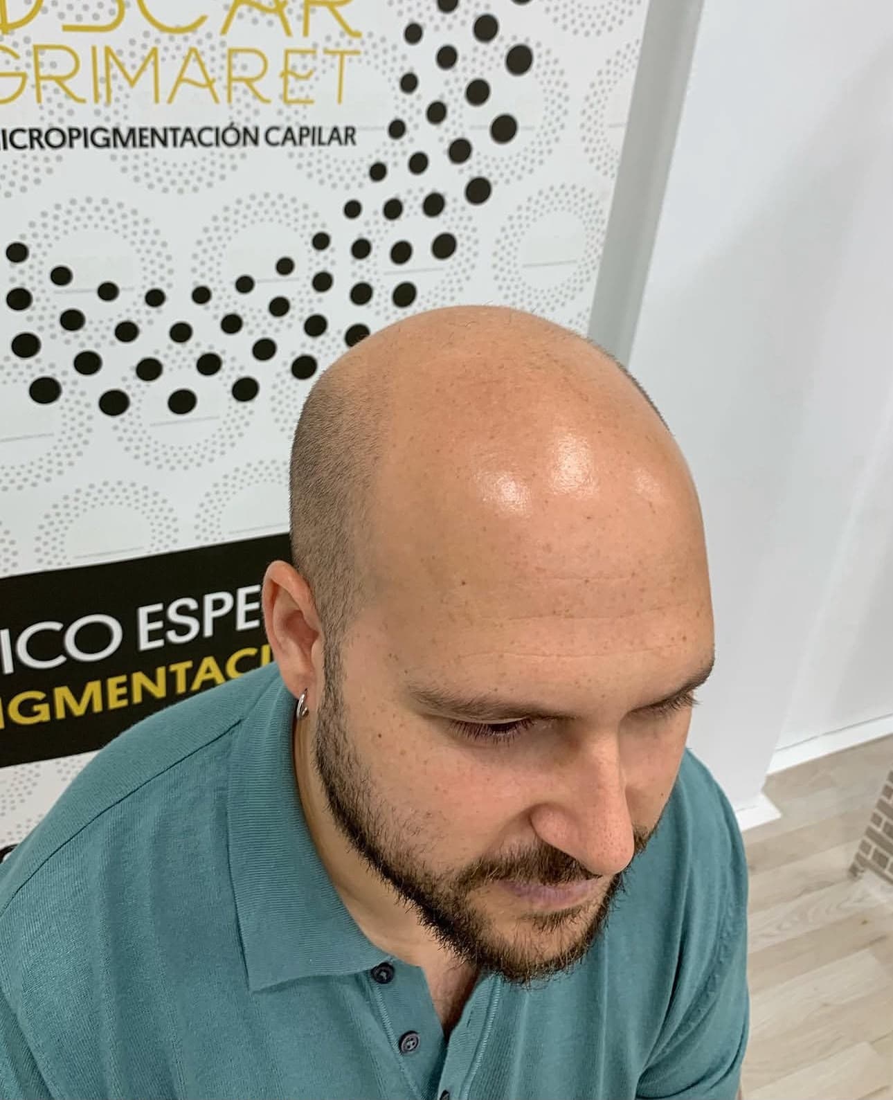 Antes: Efecto rapado con diseño frontal personalizado